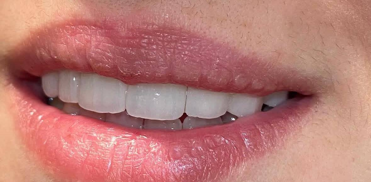 После лечения